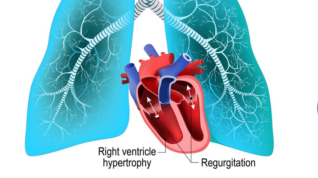 Pulmonary Hypertension | Division of Cardiology