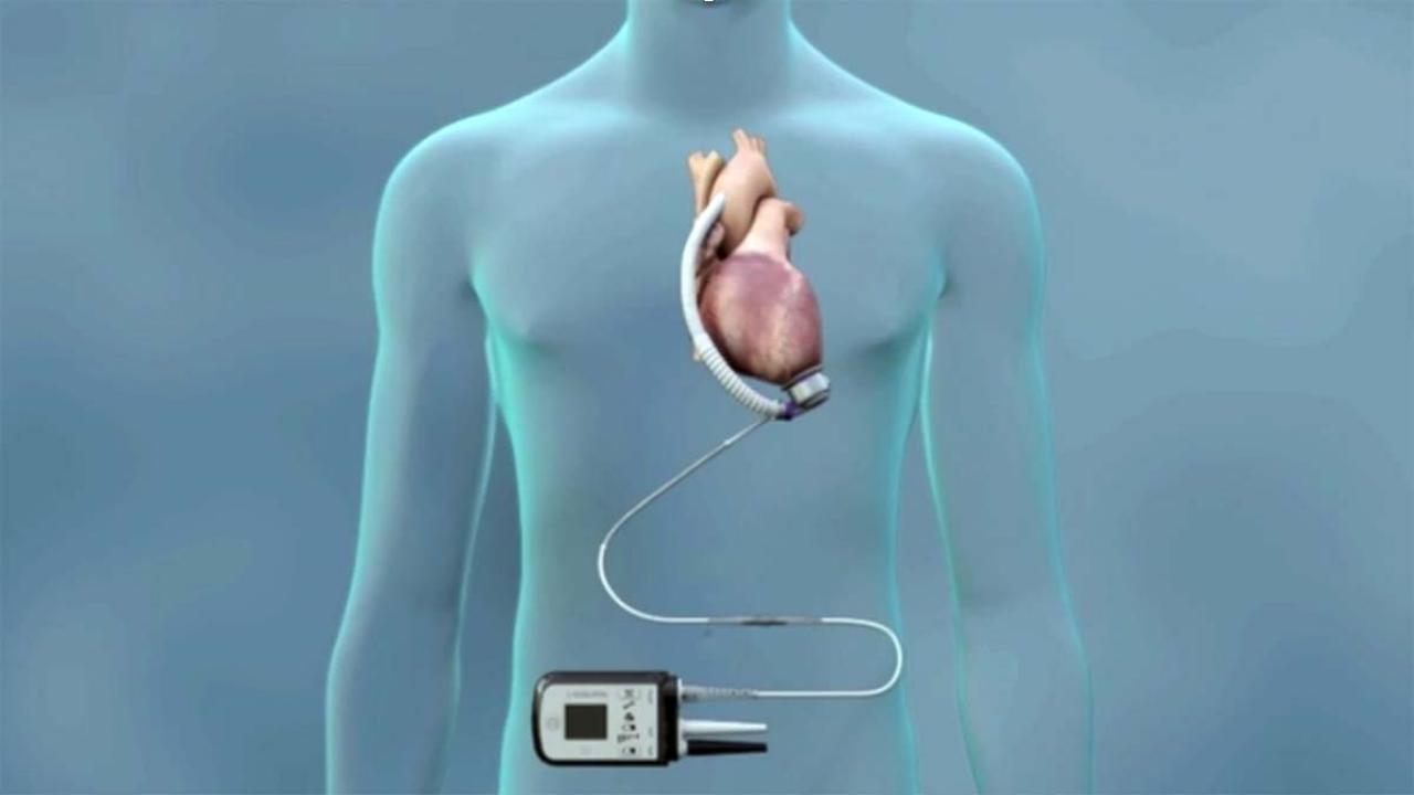 Recovery after lvad implant surgery