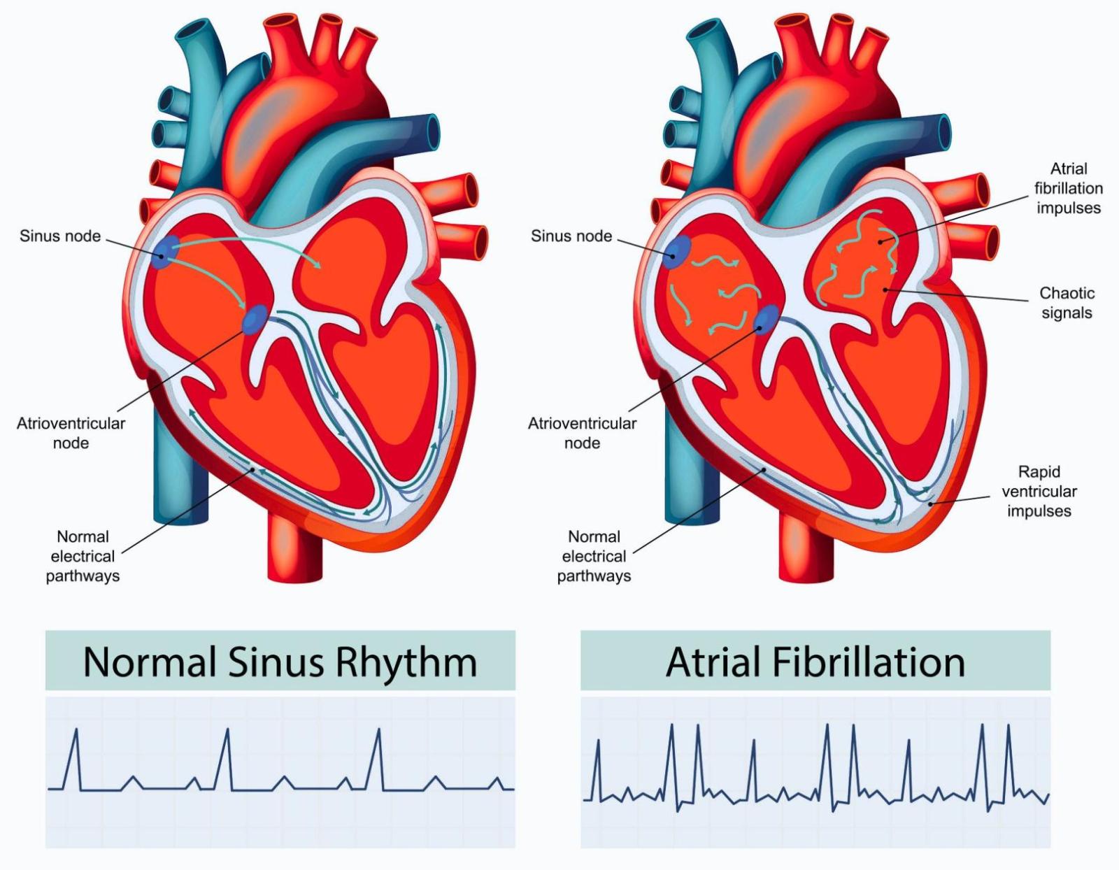 What Comes Next: Atrial Fibrillation | Division of Cardiology