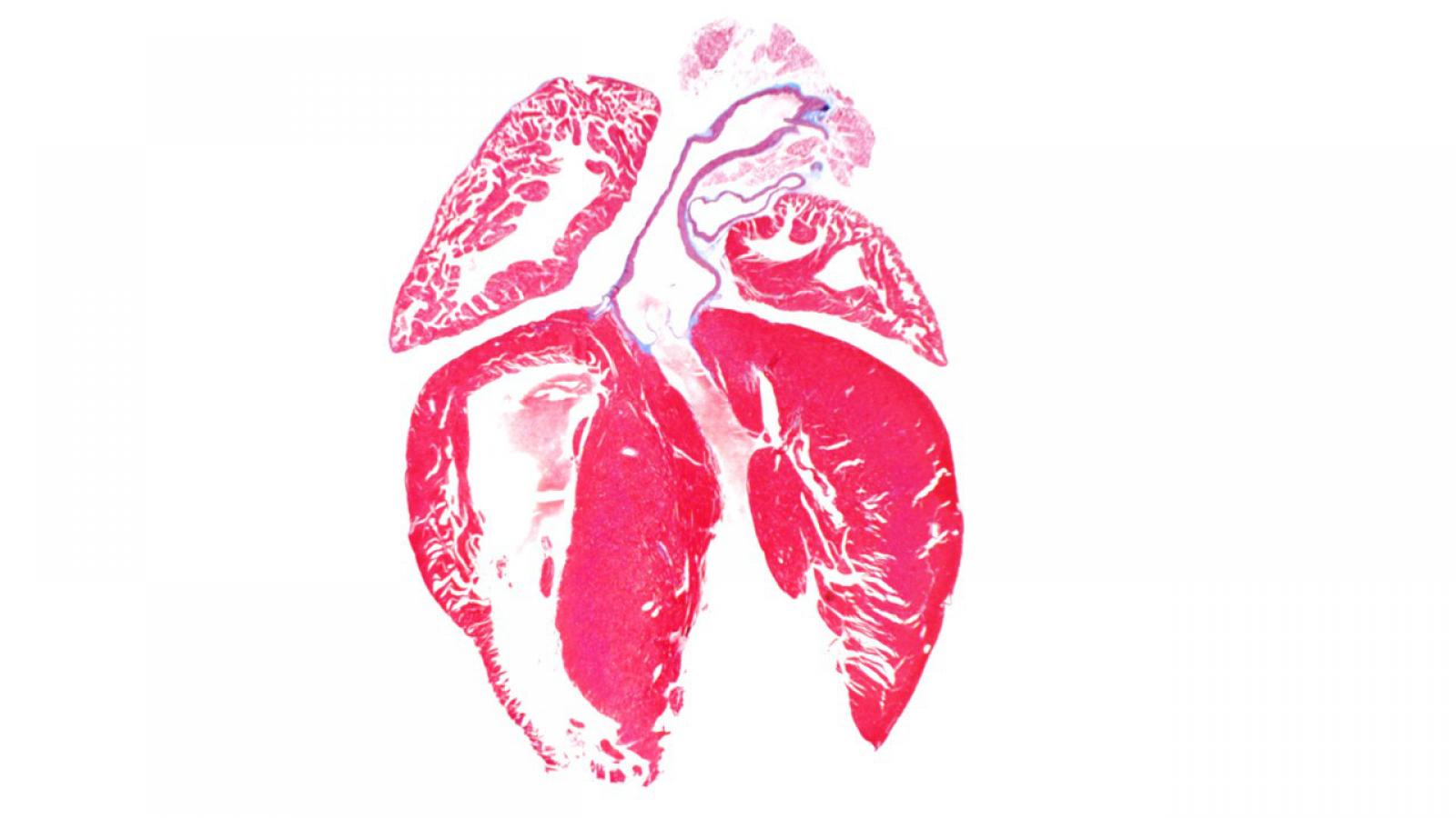 Enlarged Atria in F1759A-Na(V)1.5 mouse