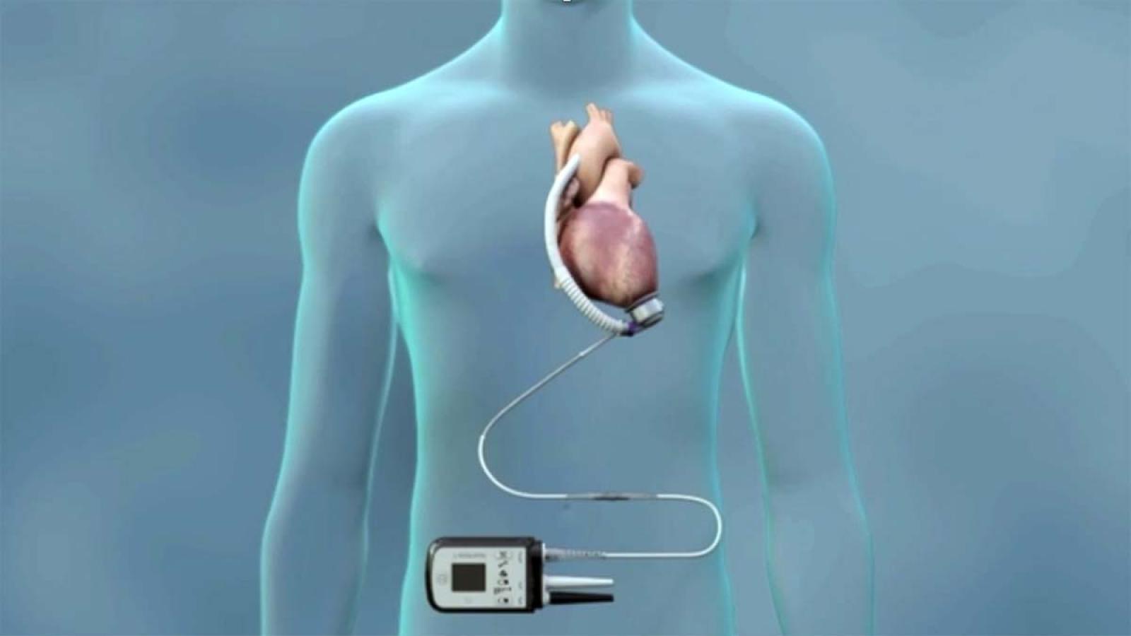 Left Ventricular Assist Devices (LVADs) Division of Cardiology