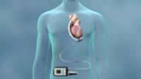 illustration of Ventricular Assist Device