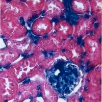 gross anatomical evidence of hepatosteatosis plus abnormal acyl carnitine serum profiles in panel